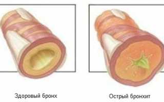 Сколько держится температура при бронхите у детей и как ее сбивать